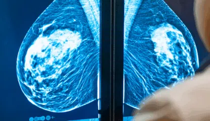 AI Is Already Helping Doctors Spot Breast Cancer Earlier — and Save Lives